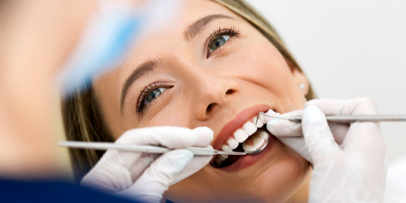 dental veneers