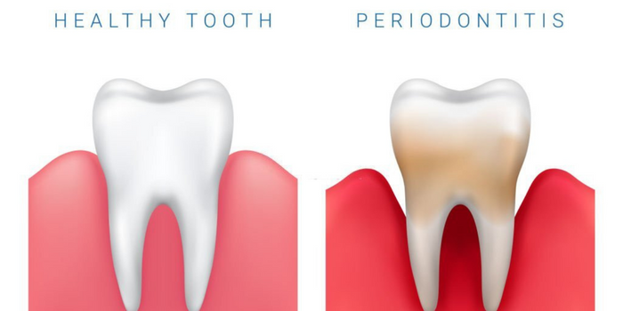 Periodontitis
